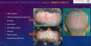 Hair Transplant method Folucular Unit Extraction