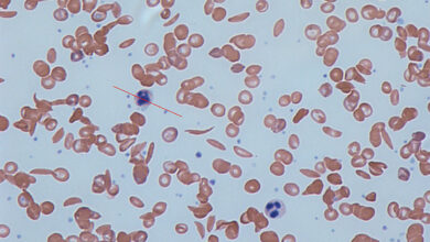 Sickle Cell Disease