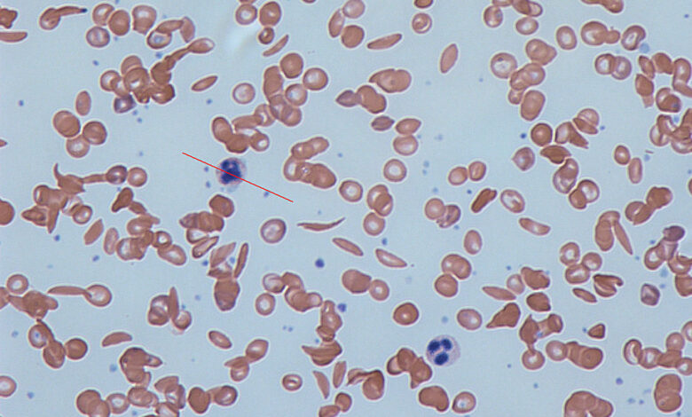 Sickle Cell Disease